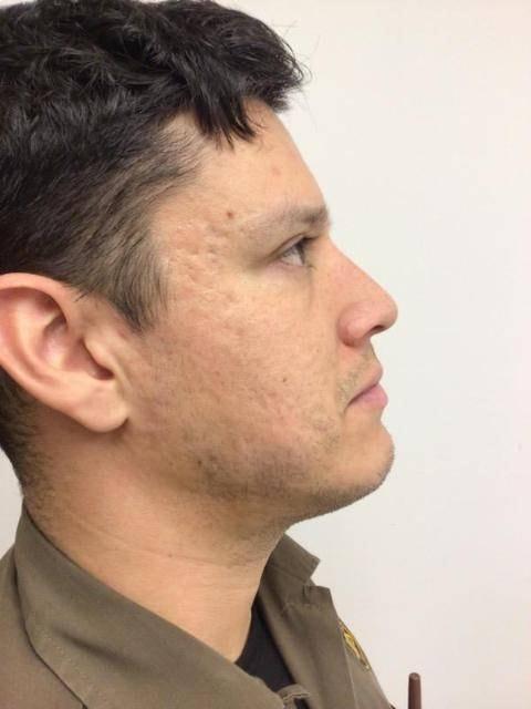 Morpheus8 before at Gorin Plastic Surgery and Med Spa in Tualatin, OR