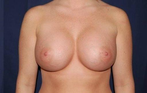 Gorin Plastic Surgery and Med Spa breast augmentation after — Tualatin, OR