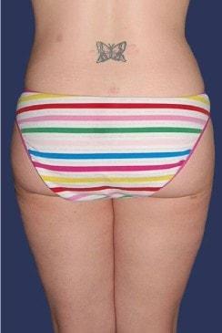 Gorin Plastic Surgery and Med Spa liposuction after — Tualatin, OR