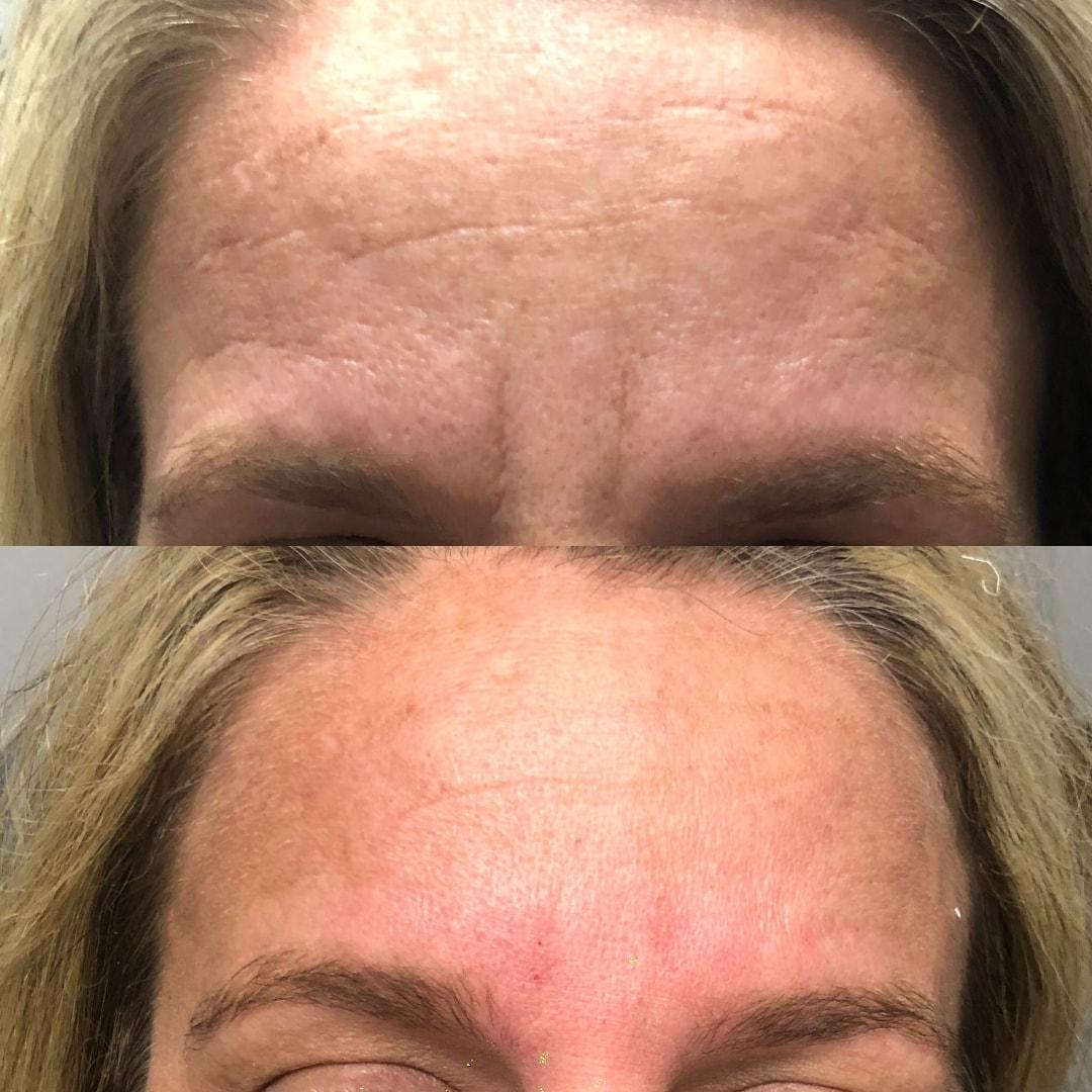 Viso Bespoke Aesthetics botox result — Salt Lake City, UT