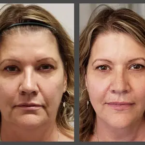 Viso Bespoke Aesthetics thread lift result — Salt Lake City, UT