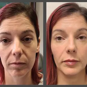 Viso Bespoke Aesthetics result — Salt Lake City, UT