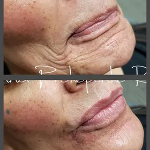 Viso Bespoke Aesthetics result — Salt Lake City, UT