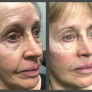 Viso Bespoke Aesthetics result — Salt Lake City, UT