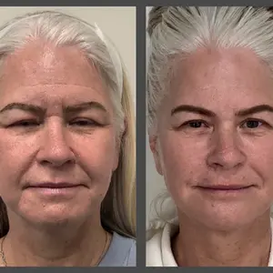 Viso Bespoke Aesthetics result — Salt Lake City, UT