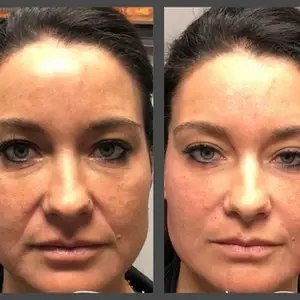Dermal Fillers result at Viso Bespoke Aesthetics in Salt Lake City, UT
