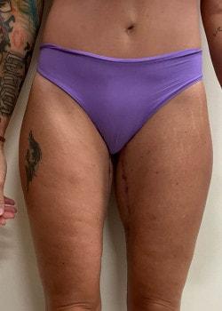 American Surgical Arts (Dr. Bidic) thigh lift after — Harrison Township, NJ
