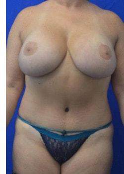 American Surgical Arts (Dr. Bidic) mommy makeover after — Harrison Township, NJ