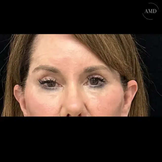 Brow Lift after at Mark A. Anton MD, FACS - Aesthetics MD Plastic Surgery & MedSpa in Newport Beach, CA
