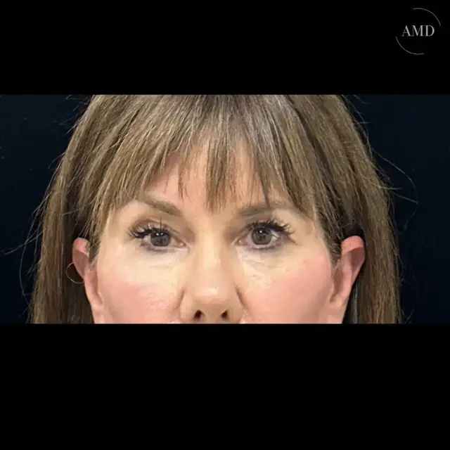 Brow Lift before at Mark A. Anton MD, FACS - Aesthetics MD Plastic Surgery & MedSpa in Newport Beach, CA