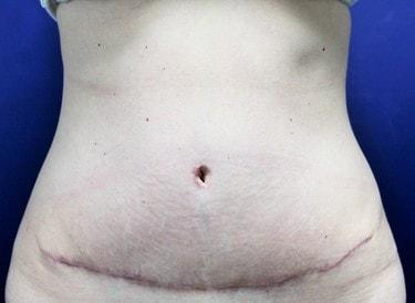 The Sendi Cosmetic Surgery Center (Susan Buenaventura, MD) tummy tuck after — Alexandria, VA