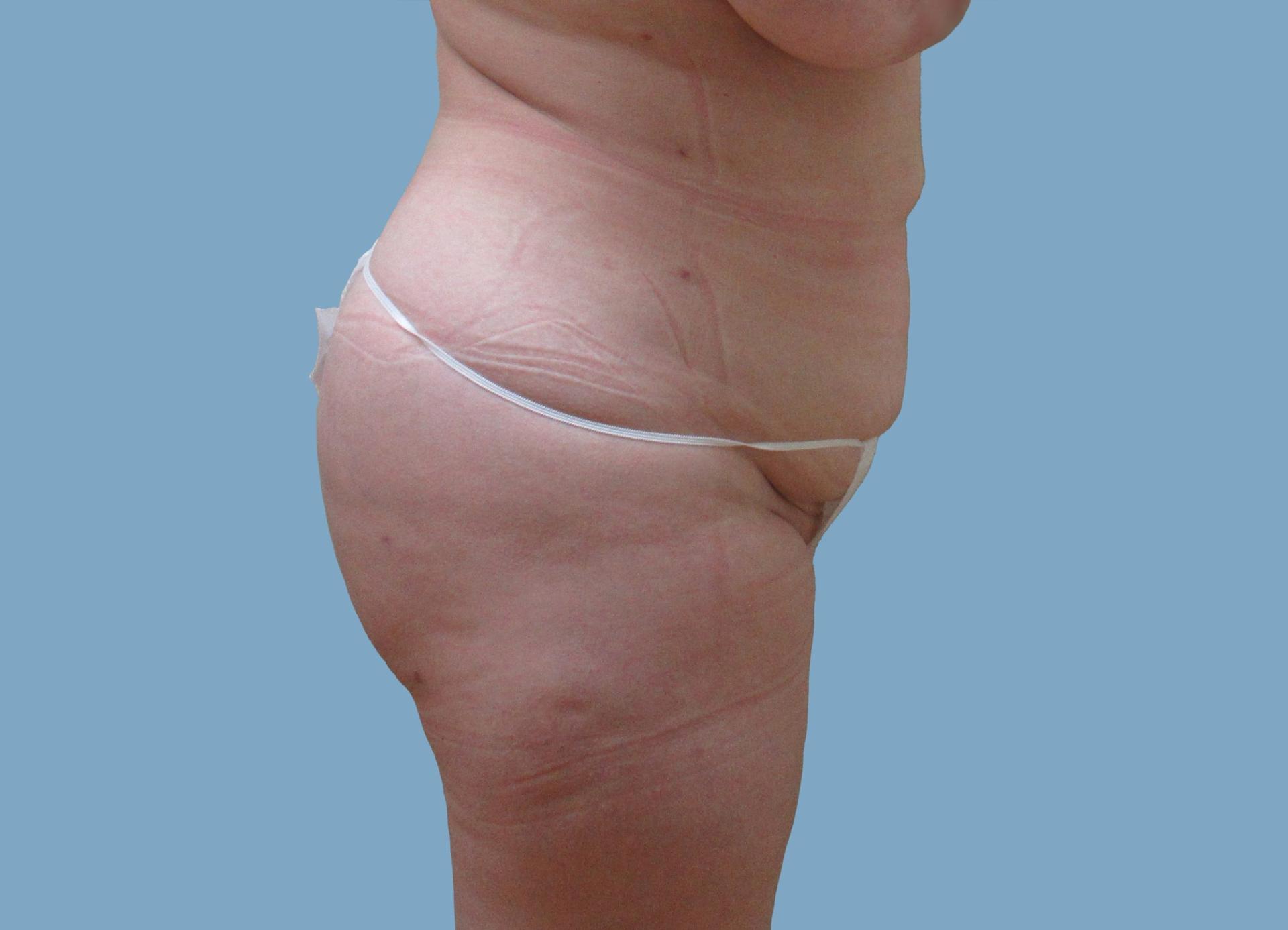 Lyle M. Back, MD bbl after — Cherry Hill Township, NJ