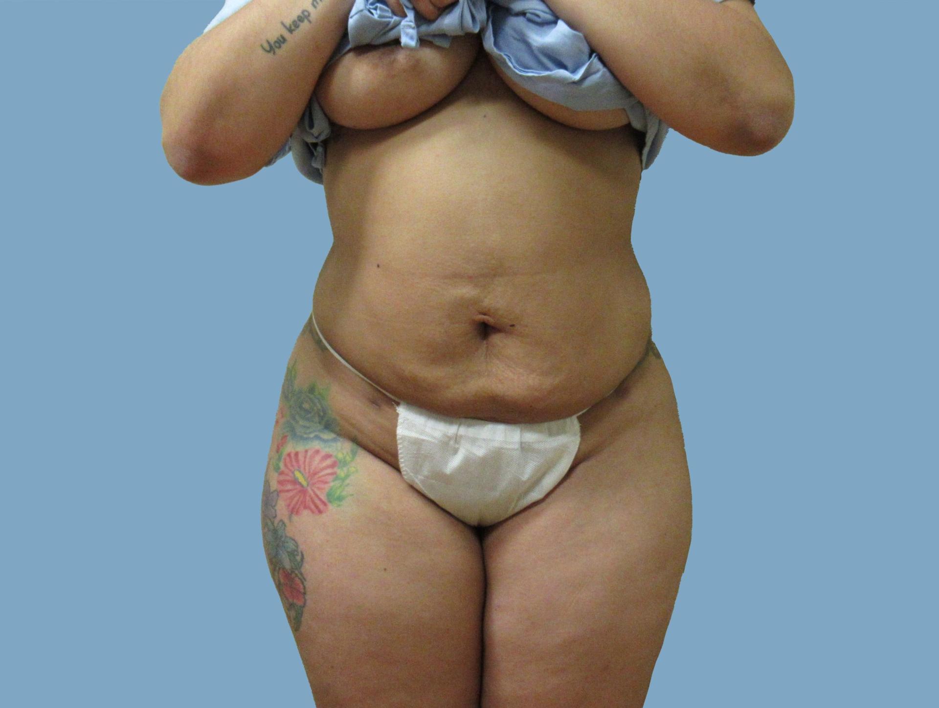Lyle M. Back, MD liposuction after — Cherry Hill Township, NJ