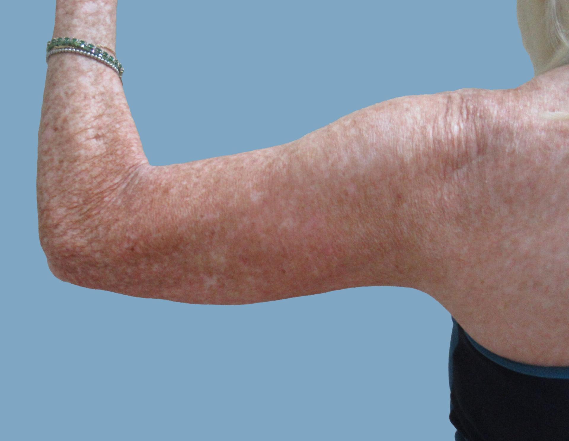 Lyle M. Back, MD arm lift after — Cherry Hill Township, NJ