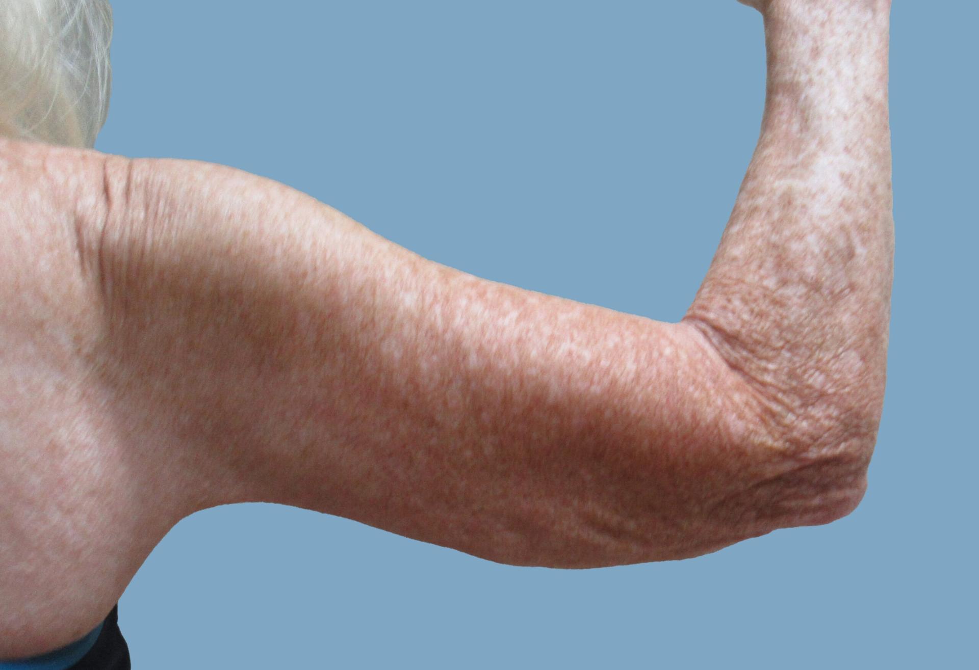 Lyle M. Back, MD arm lift after — Cherry Hill Township, NJ