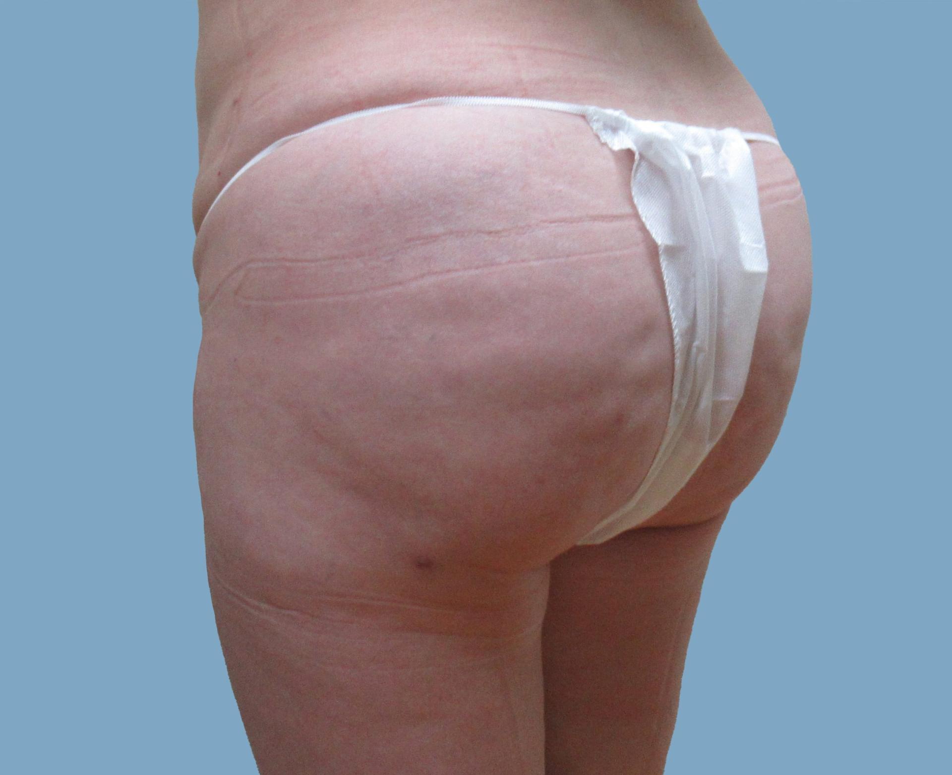 Lyle M. Back, MD bbl after — Cherry Hill Township, NJ
