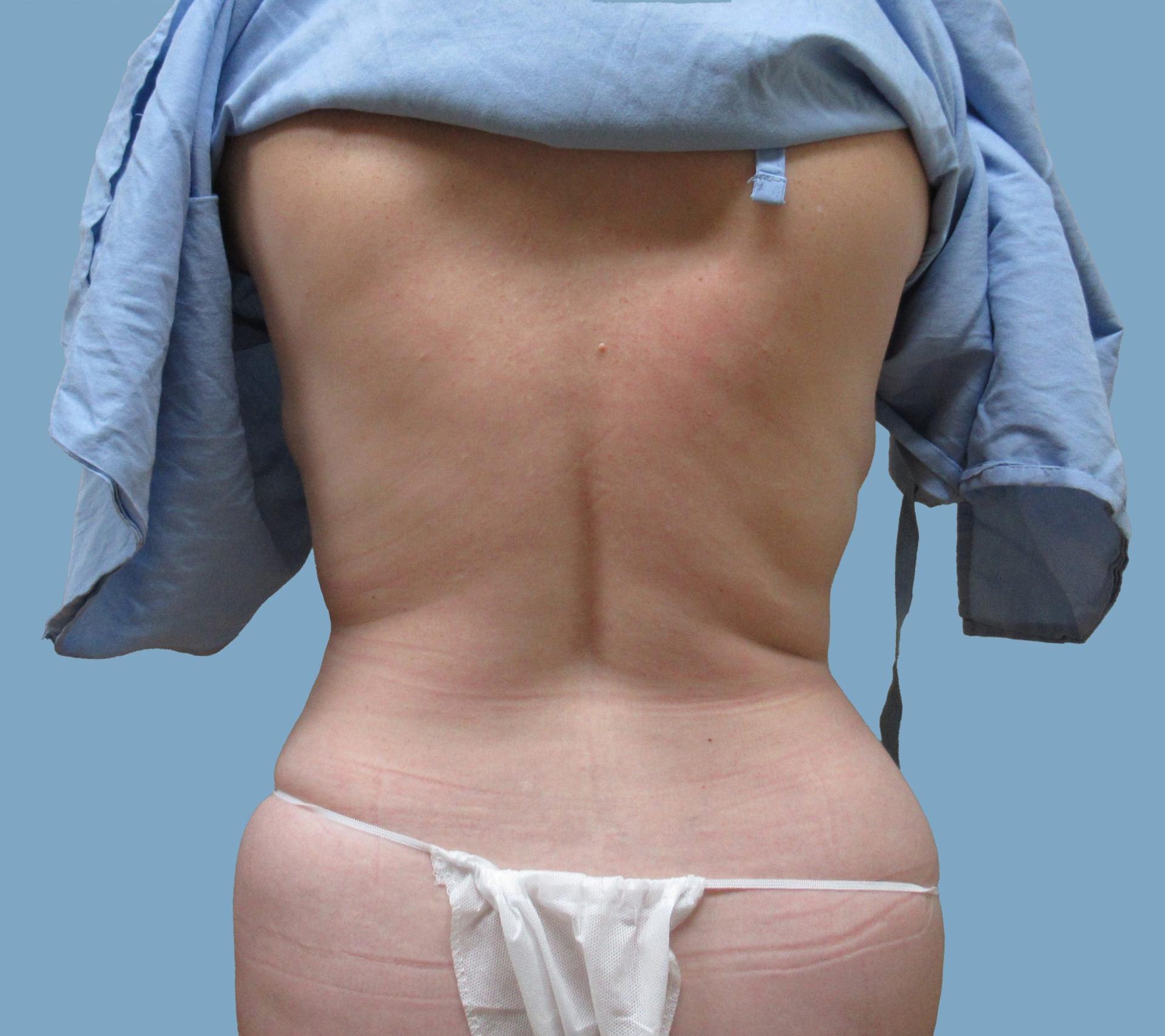 Lyle M. Back, MD liposuction after — Cherry Hill Township, NJ