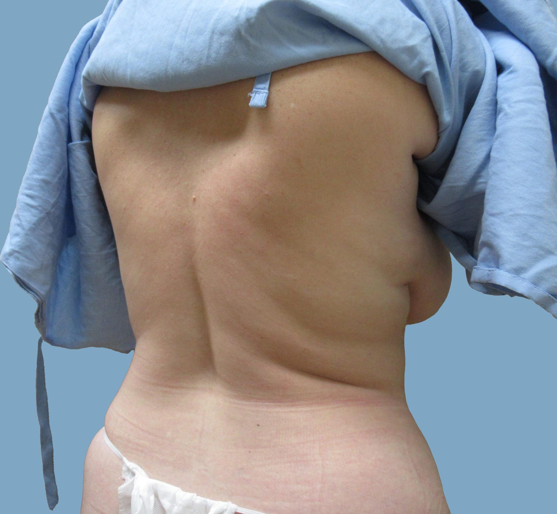 Lyle M. Back, MD liposuction after — Cherry Hill Township, NJ