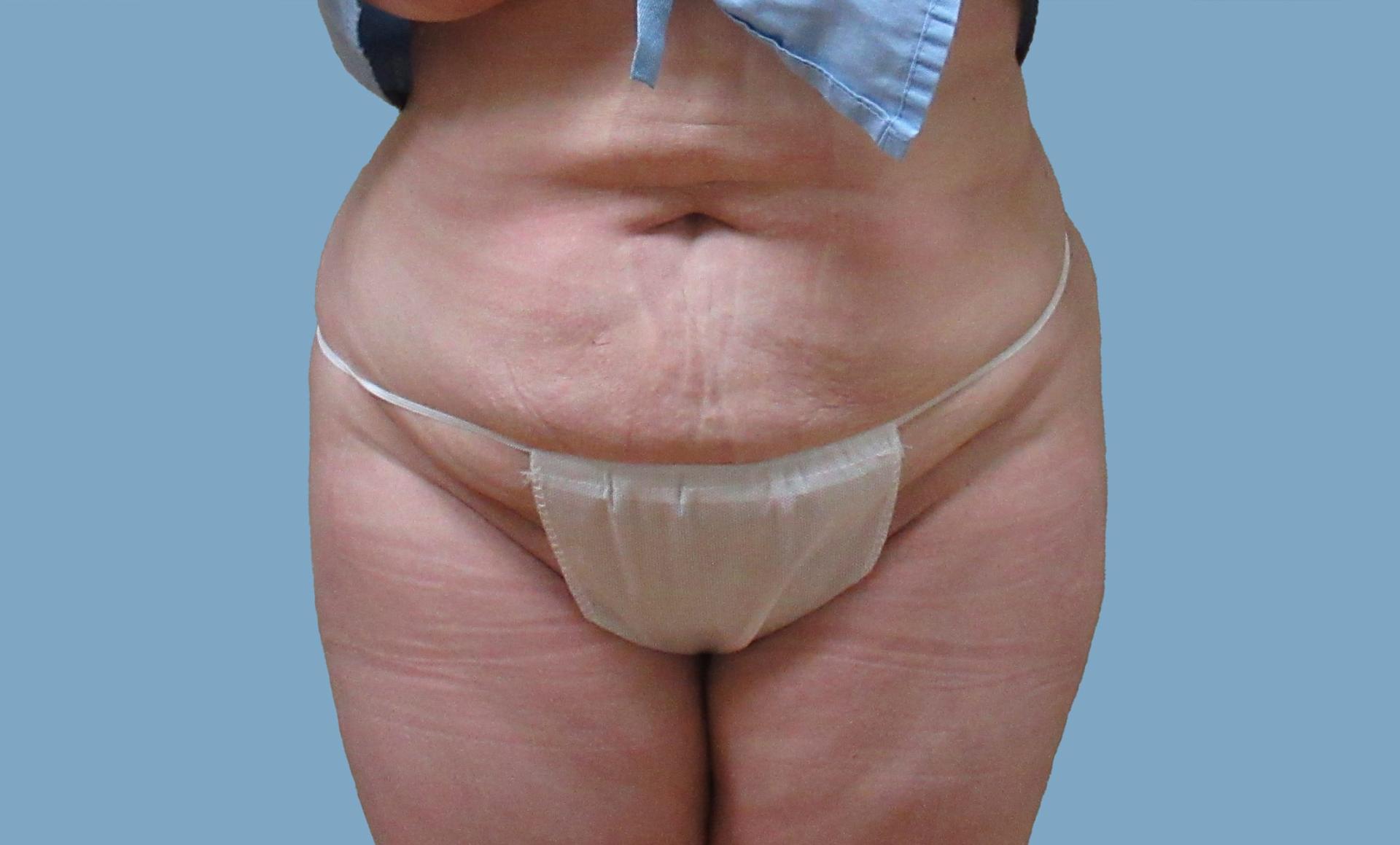 Lyle M. Back, MD liposuction after — Cherry Hill Township, NJ