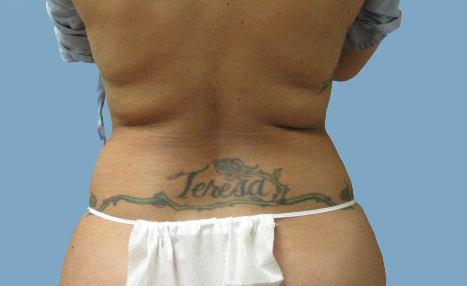 Lyle M. Back, MD liposuction after — Cherry Hill Township, NJ