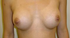 Edmund Kwan, MD breast augmentation after — New York, NY