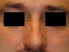 Edmund Kwan, MD rhinoplasty after — New York, NY