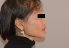 Edmund Kwan, MD facelift after — New York, NY