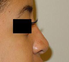 Edmund Kwan, MD rhinoplasty after — New York, NY