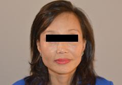 Edmund Kwan, MD facelift after — New York, NY