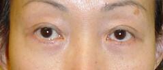 Edmund Kwan, MD blepharoplasty after — New York, NY