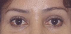 Brow Lift after at Edmund Kwan, MD in New York, NY