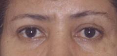 Brow Lift before at Edmund Kwan, MD in New York, NY