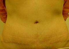 Edmund Kwan, MD tummy tuck after — New York, NY