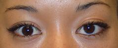 Blepharoplasty after at Edmund Kwan, MD in New York, NY