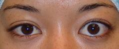 Blepharoplasty before at Edmund Kwan, MD in New York, NY