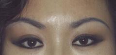 Brow Lift after at Edmund Kwan, MD in New York, NY