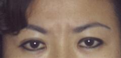 Brow Lift before at Edmund Kwan, MD in New York, NY