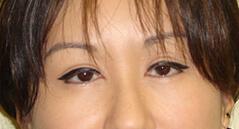 Brow Lift after at Edmund Kwan, MD in New York, NY