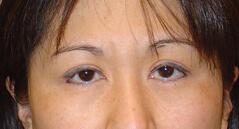 Brow Lift before at Edmund Kwan, MD in New York, NY