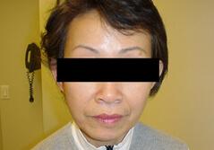 Edmund Kwan, MD facelift after — New York, NY