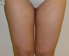 Edmund Kwan, MD liposuction after — New York, NY