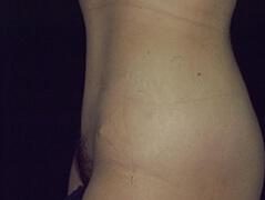 Edmund Kwan, MD tummy tuck after — New York, NY