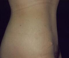 Edmund Kwan, MD liposuction after — New York, NY