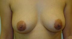 Edmund Kwan, MD breast augmentation after — New York, NY