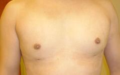 Edmund Kwan, MD gynecomastia after — New York, NY