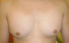 Gynecomastia Surgery before at Edmund Kwan, MD in New York, NY