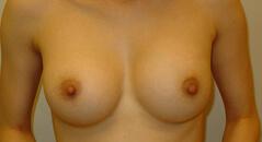 Edmund Kwan, MD breast augmentation after — New York, NY