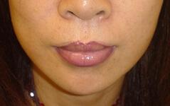 Juvederm after at Edmund Kwan, MD in New York, NY