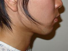 Chin Implant before at Edmund Kwan, MD in New York, NY