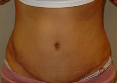 Edmund Kwan, MD tummy tuck after — New York, NY